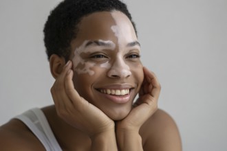 Smiling Black woman with vitiligo resting her hands near her face. Embracing beauty in diversity
