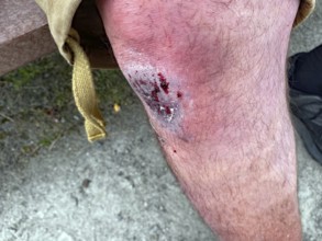 Close-up of injured knee with skin abrasion and wound, fall, bike travel, Scotland, United Kingdom