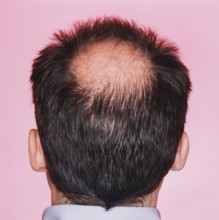 Close-up of the back of a man's head with a distinct bald head or hair loss