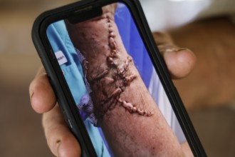 Close-up of a healed scar from a crocodile attack on a smartphone, Adelaide River, Northern