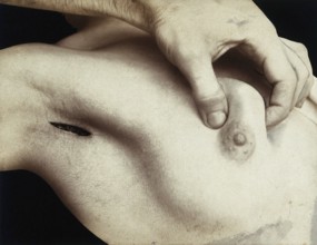 Patient, surgery, breast surgery, lump removal, tumor, metal surgical instrument inserted through