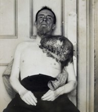 Bone cancer, malignant tumor, sarcoma, man with a large periosteal sarcoma, that from his shoulder.