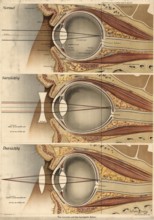 Medical illustration, defective vision of the human eye, school picture, authentic reproduction of