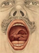 Medical illustration, clinical picture, venereal disease, palate perforation caused by syphilis,