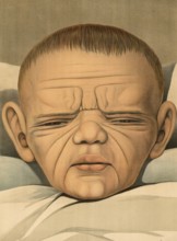 Medical illustration, clinical picture, venereal disease, syphilis, hereditary syphilis, child with