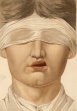 Medical illustration, clinical picture, venereal disease, primary affect of syphilis on the upper