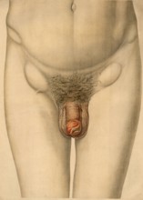Medical illustration, clinical picture, venereal disease, primary affect of syphilis on the male