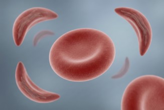 Visualization of CRISPR gene therapy for sickle cell anemia: An altered red blood cell that