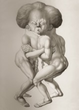 Twins conjoined at the head and thorax, drawing c 1830, digitally edited