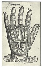 Prothèse de main par Ambroise Paré