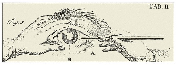 Engraving representing an eye surgery