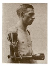 Artificial arm developed by Ferdinand Sauerbruch
