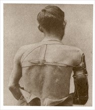 Prothèse du bras mise au point par Ferdinand Sauerbruch