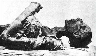 Momie du Pharaon Ramsès II, mort de la variole