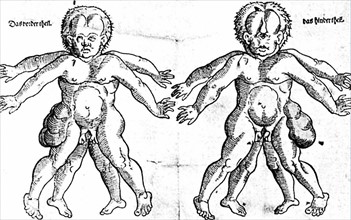 Misshapen children (illustration from a Nuremberg book, 1578)