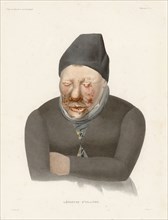 Sick with leprosy, 1835