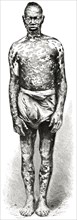 Man with Mottled Skin, Loango Coast, Africa, Illustration, 1885