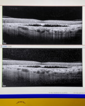 OCT scan (Optical Coherence Tomography) of human retina, both eyes