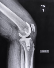 X-ray of adult man's knee after knee replacement surgery