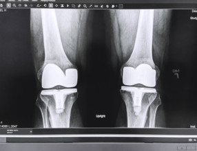 X-ray of adult man's knees after knee replacement surgery