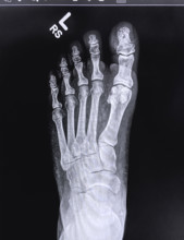 X-ray of broken toe on left foot