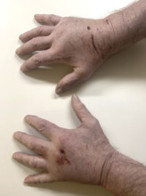 Cat scratches on man's hands
