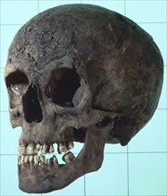 Female syphilitic skull with multiple erosive lesions. Artist: Unknown