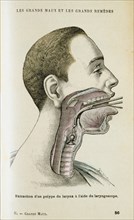 Using a laryngoscope to aid the removal of a polyp from the throat, c1890. Artist: Unknown