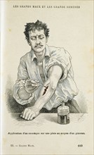 Painting a wound with an antiseptic solution, c1890. Artist: Unknown