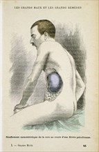 Typical enlarged spleen of a Malaria patient, c1890. Artist: Unknown