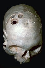 Trepanned Skull. Artist: Unknown