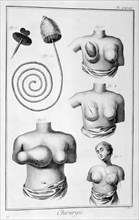 Breast surgery, 1751-1777. Artist: Unknown