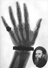 X-ray photograph of a hand, 1926. Artist: Unknown