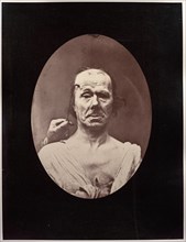 Figure 7: Étude du méchanisme et de lexpression du muscle frontal chez un vieillard: à droit..., c.  Creator: Guillaume-Benjamin-Amand Duchenne (de Boulogne) (French, 1806-1875); Adrien Tournachon (Fr...