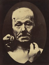 Figure 8: Contraction of the right m. frontalis. , 1854-56, printed 1862.