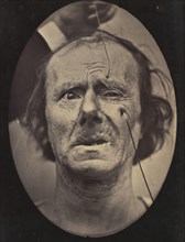 Figure 49: Painful weeping and forward looking., 1854-56, printed 1862.