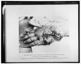 Photographie de la blessure causée par une balle explosible..., 1914. Creator: Harris & Ewing.