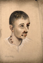Head of a woman with a severe disease affecting her face and neck, 1864. Creator: Christopher D'Alton.