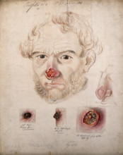 Head of a man with a severe disease affecting his nose; a detail of the nose..., 1800-1899. Creator: Christopher D'Alton.