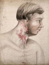Head and chest of a man with a disease affecting his neck, seen in profile, 1856. Creator: Christopher D'Alton.