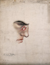 A detail of a man's face seen in profile with a severe disease affecting his nose, 1856. Creator: Christopher D'Alton.