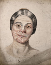 Head of a woman with a severe disease affecting her face, 1800-1899. Creator: Christopher D'Alton.