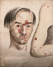 Head of a man with a severe disease affecting his face; and a section of diseased arm, 1800-1899. Creator: Christopher D'Alton.