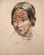 Head of a woman with a severe disease affecting her face, (18)58. Creator: Christopher D'Alton.