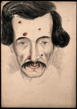 Head of a man with a disease affecting his face, 1800-1899. Creator: Christopher D'Alton.
