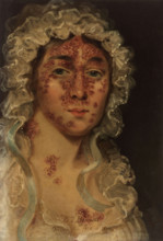 Mrs Bennett, afflicted with a skin disease, between 1818 and 1821. Creator: Unknown.