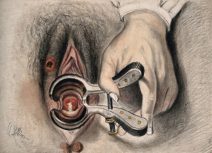 An infected sore on the female genitalia shown with the aid of a vaginal speculum, 1800-1899. Creator: Christopher D'Alton.