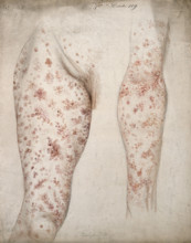 Sores and diseased skin on the leg and arm of a woman, 1856. Creator: Christopher D'Alton.