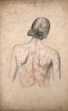 Back of a woman suffering from a rash of sores, 1855. Creator: Christopher D'Alton.