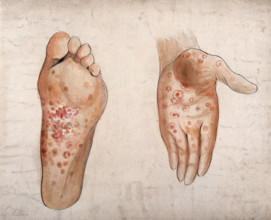Diseased tissue on the palm of the hand and sole of the foot of a man, (1853?). Creator: Christopher D'Alton.